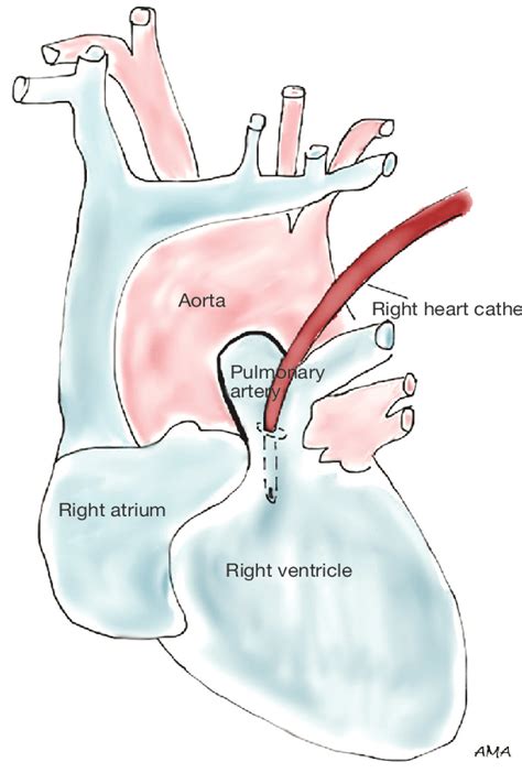 lv bypasser|partial left heart bypass.